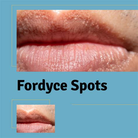 Spots On Lips Fordyce