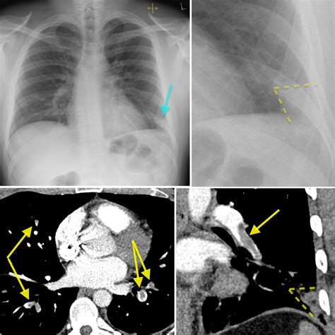 Pulmonary Embolism Chest X Ray