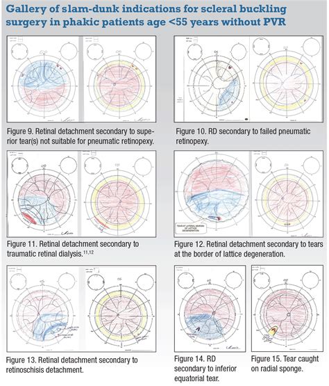 Scleral buckling surgery: As vital as ever