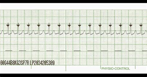 Image result for Synchronized Cardioversion EKG Strips Practice