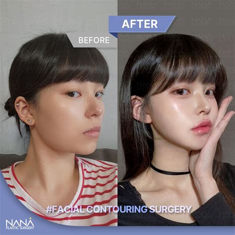 Before and after(facial contouring surgery)