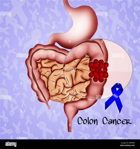Cancer de l'intestin humain Banque de photographies et d’images à haute résolution - Page 2 - Alamy