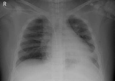 ZhangLabData: Chest X-Ray - Dataset Ninja