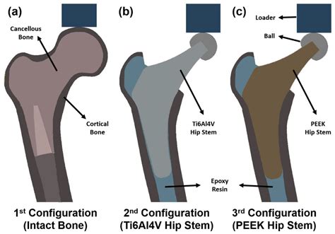 Stress Shielding and Bone Resorption of Press-Fit Polyether–Ether–Ketone (PEEK) Hip Prosthesis ...