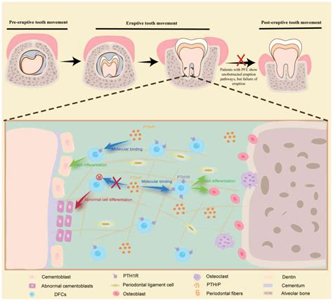 Abnormal dental follicle cells: A crucial determinant in tooth eruption disorders (Review)