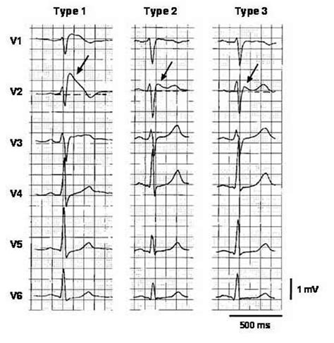 Brugada Syndrome - Causes, ECG, Symptoms, Treatment
