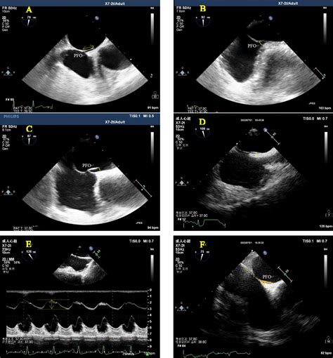 PFO Defect 的图像结果