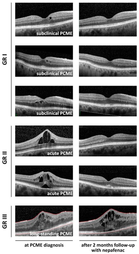 How Long Does Macular Edema Last After Cataract Surgery - Infoupdate.org