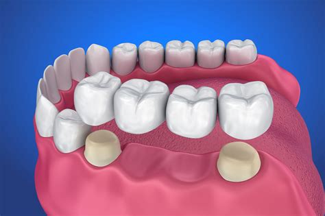 Dental Bridge With Crowns at James Boswell blog