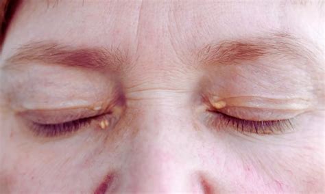 Carbon dioxide Laser Excision: A Promising Minimally Invasive Treatment ...