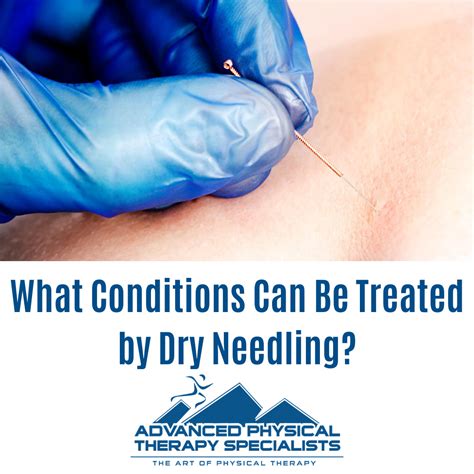 What Conditions Does Dry Needling Treat? - Advanced Physical Therapy Specialists