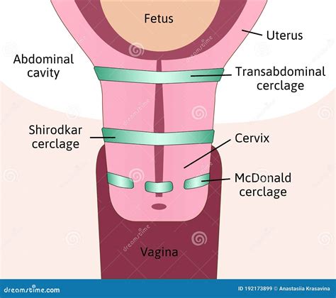Three Types of Cervical Cerclage or Cervical Stitch, Treatment for ...