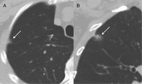 An incidental pulmonary part-solid ground-glass nodule in a patient under anticoagulant therapy ...
