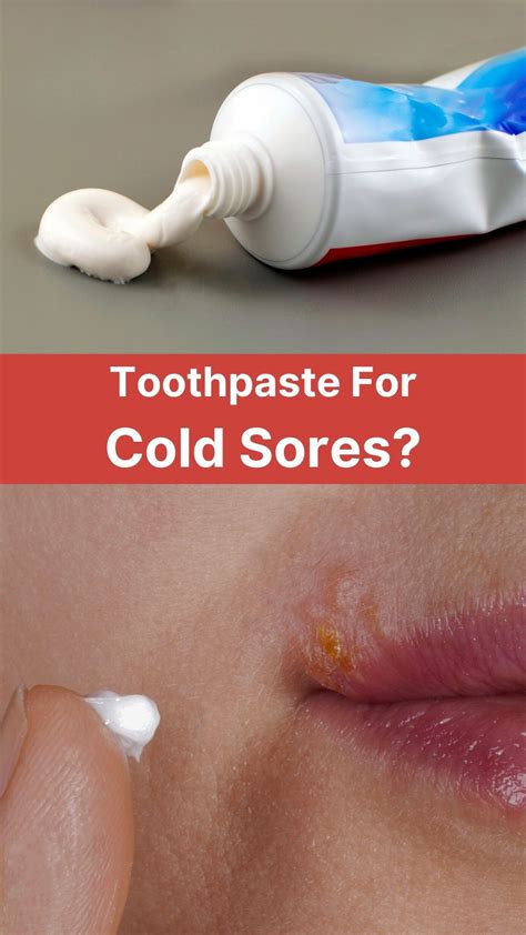 Toothpaste On Cold Sore