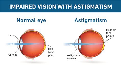Laser Cataract Surgery And Astigmatism at Samuel Truelove blog