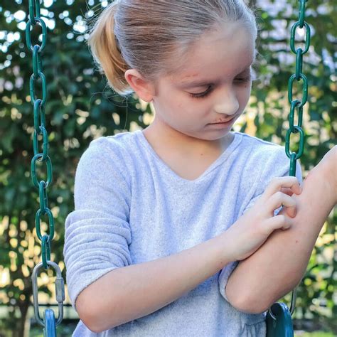 Das atopische Ekzem im Kindes- und Jugendalter - Dermatologie ...