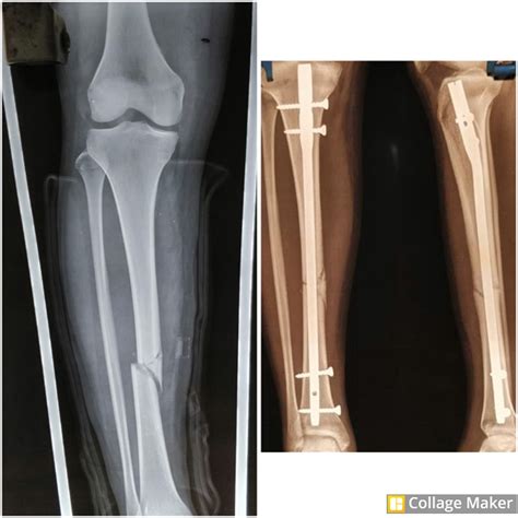 Role of fibula in healing of closed diaphyseal tibial fractures treated ...