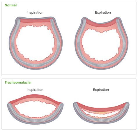 Laringomalacia y Traqueomalacia | Concise Medical Knowledge