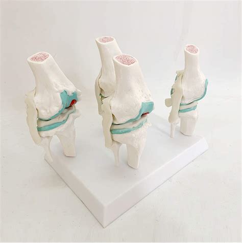 Buy WEDF Educational Model Knee Joint Model Anatomy Human Lesion Knee 1 ...