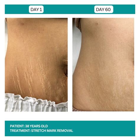 Stretch Mark Removal