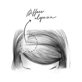 Image result for Diffuse Alopecia