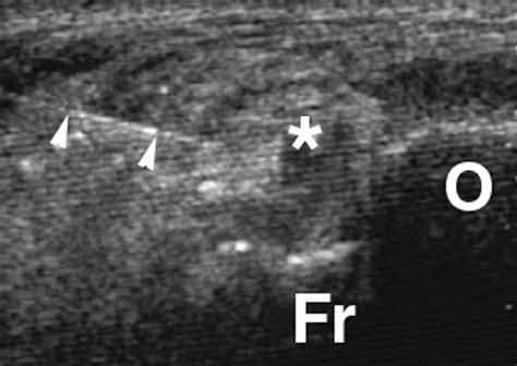 Posterior Ankle Impingement in Professional Soccer Players: Effectiveness of Sonographically ...