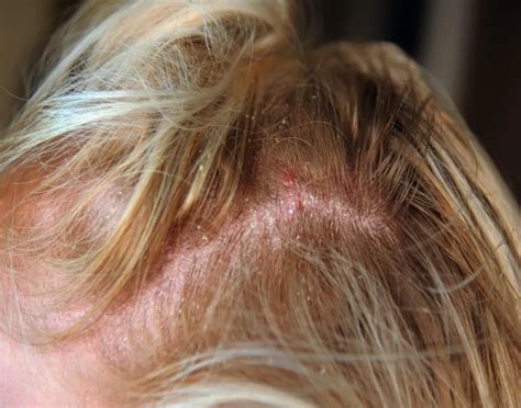 Scalp Redness: Causes, Diagnosis and Do’s & Don’ts
