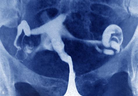 Methotrexate Injection For Ectopic Pregnancy