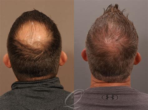 Male FUE Hair Transplant Before & After Photos Patient 1001537 ...