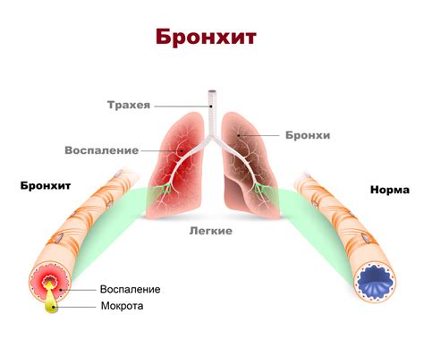 Бронхит: симптомы и лечение, причины заболевания и осложнения