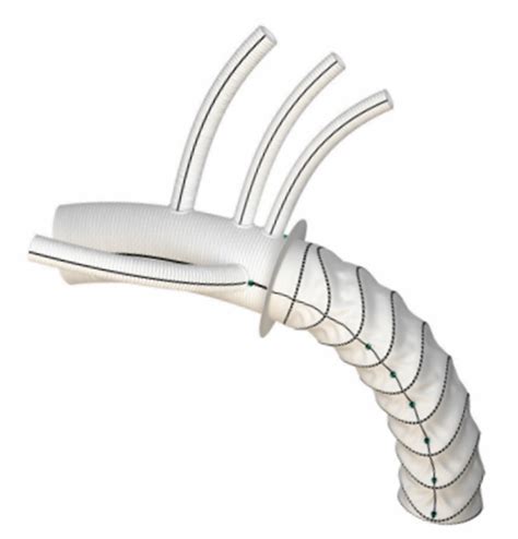 Hybrid Approach in Acute and Chronic Aortic Disease