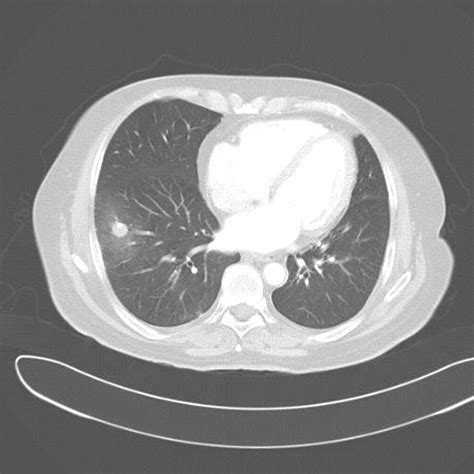 What is a pulmonary embolism, the condition that led to Catherine O’Hara’s death? | CNN