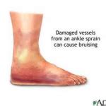 How Long Does a Sprained Ankle Take to Heal - Muscle Pull | Muscle Pull