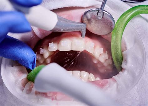 Is it Painful to Get Teeth Cleaned? Dispelling Dental Myths – Tooth Truths