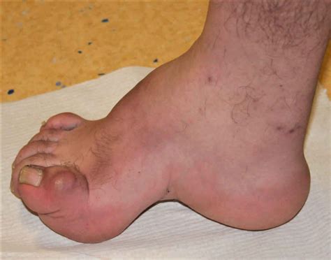 Pes cavus foot definition, causes, symptoms, diagnosis & treatment