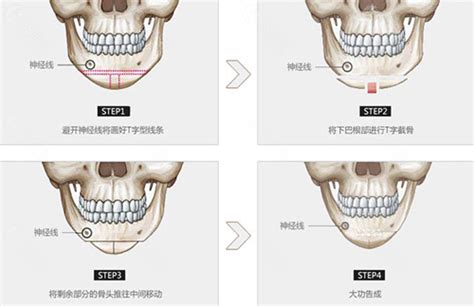 亲历下颌角磨骨手术过程,分享张立天磨骨三个月案例效果!,下颌角整形-8682赴韩整形网
