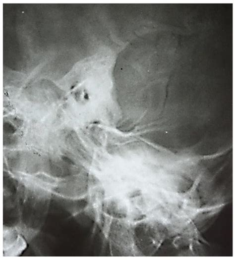 Comprehensive Management of Cholesteatoma in Otitis Media: Diagnostic ...