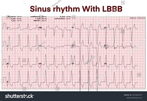 Electrocardiogram Show Sinus Rhythm Left Bundle Stock Illustration 2257623727 | Shutterstock