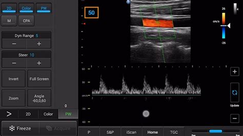 Innosight tutorial videos | Philips Healthcare