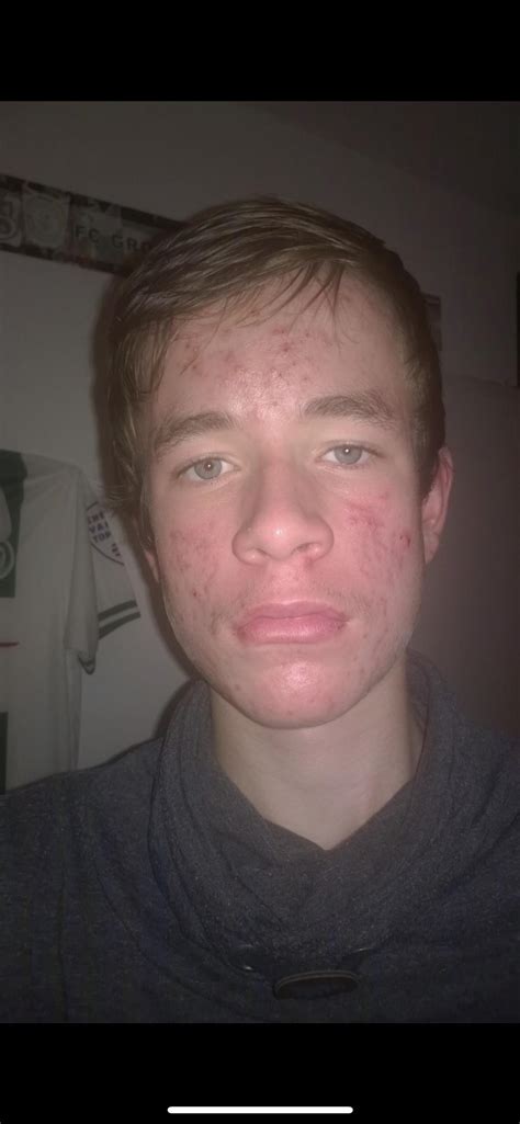 HUGE Glow up/Success Story : acne