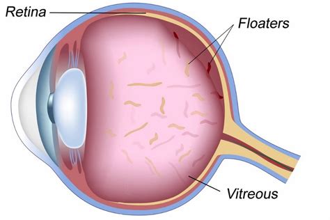 Image result for Eye Floater Types