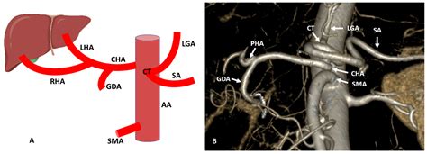 Hepatic Artery Proper