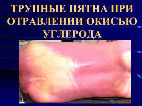 ОБЩАЯ ТАНАТОЛОГИЯ. РАННИЕ И ПОЗДНИЕ ТРУПНЫЕ ЯВЛЕНИЯ