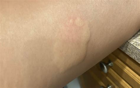 Image result for Injection Reactions