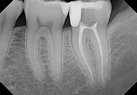 Dexis Titanium Sensor 的图像结果