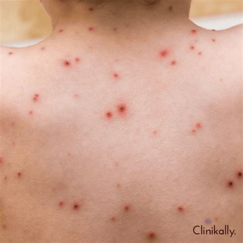 10 Fastest Ways to Treat Chicken Pox Scars | Clinikally