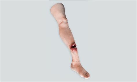 Open Fracture Leg | undefined | Medical-X