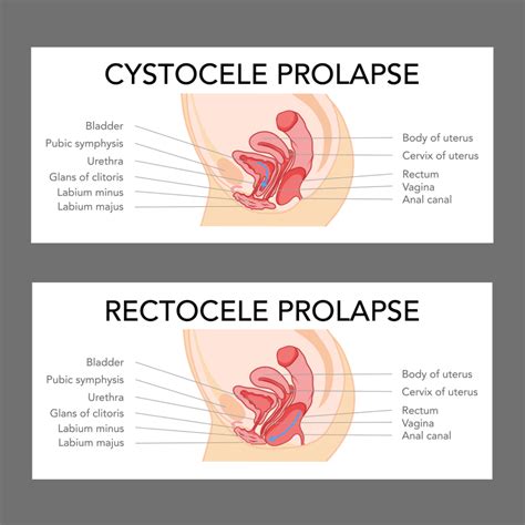 Prolapsed Bladder After Hysterectomy
