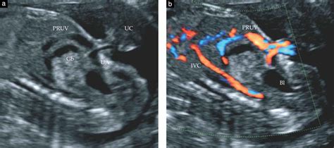 Bildergebnis für normal umbilical cord ultrasound