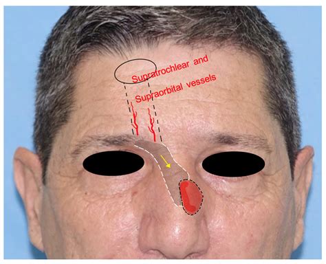 Locoregional Flaps for the Reconstruction of Midface Skin Defects: A ...